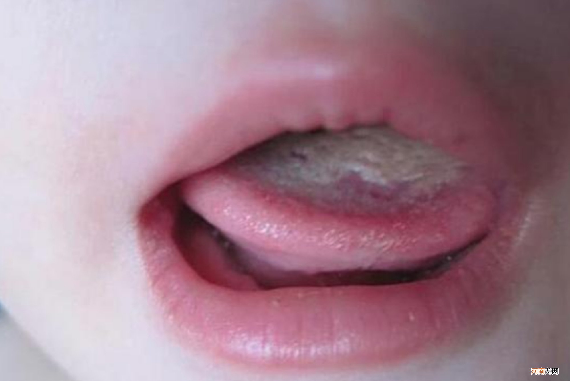 6岁男童积食不长个，医生看舌苔后捂鼻问：“防腐剂”吃了多少