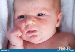 防新生儿脓疱疮应注意什么