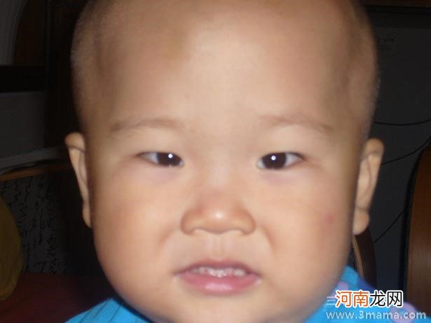 一发现孩子斜视就应治疗