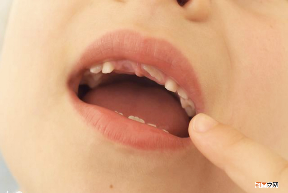 宝宝磨牙容易造成牙齿损伤，还影响脸型变化，瓜子脸变国字脸