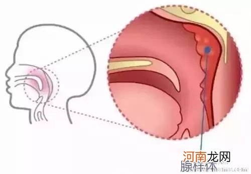 孩子腺样体肥大如何治疗