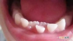 乳牙为何比恒牙更易患龋齿