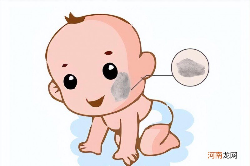 新生儿的胎记应该怎么去除 宝宝的胎记可以去掉吗