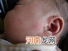 婴儿患湿疹不宜母乳涂抹