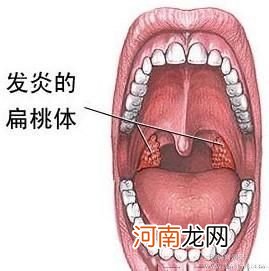 孩子扁桃体要不要“下岗”？