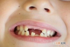 什么情况下孩子乳牙必须拔？