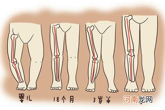 腿不直≠O型腿，宝宝是不是O型腿，应该这样判断！