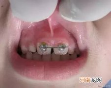 提醒：儿童牙颌畸形尽早治