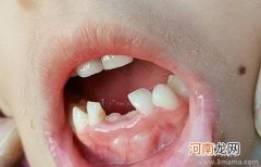 儿童换牙期要不要矫正？