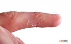 手脱皮是怎么回事 手脱皮需要吃什么维生素吗