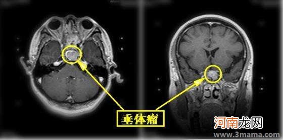 孩子“疯长”当心垂体瘤