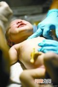 剖腹产儿童患抽动症概率高