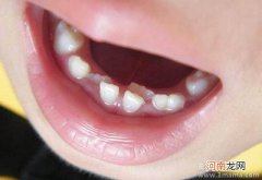 孩子换牙期如何护理牙齿？