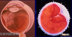 打响防御战：早产儿视网膜病变4大病因