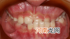 牙齿畸形半数缘于不良习惯