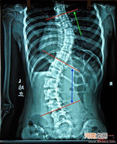 脊柱易侧弯早发现是关键