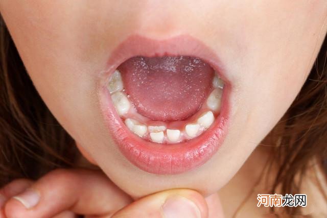 孩子为啥会长“双排牙”？跟饮食习惯有关系，家长要了解