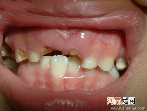 孩子乳牙龋齿应及时治疗