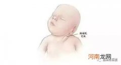 新生儿斜颈有哪些纠正方法？