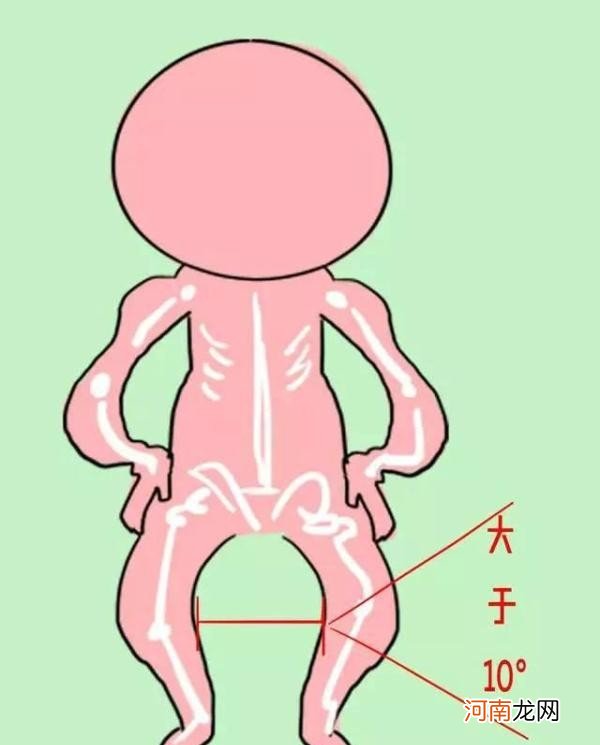 这些习惯会导致宝宝得O型腿 9个月宝宝能坐学步车吗