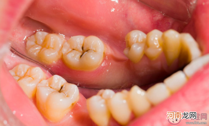 后牙槽|后牙槽上有黑线是什么 窝沟封闭可以预防窝沟龋坏吗