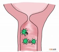 解脲支原体是什么症状 解脲支原体症状有哪些