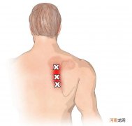 肩胛骨缝疼痛的症状 肩胛骨缝疼痛的原因