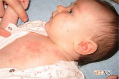 新生儿湿疹如何处理呢 新生儿湿疹怎么治疗呢