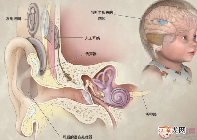人工耳蜗|人工耳蜗为什么那么贵 装人工耳蜗能达到正常人的听力吗