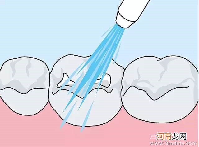 乳磨牙也应进行窝沟封闭