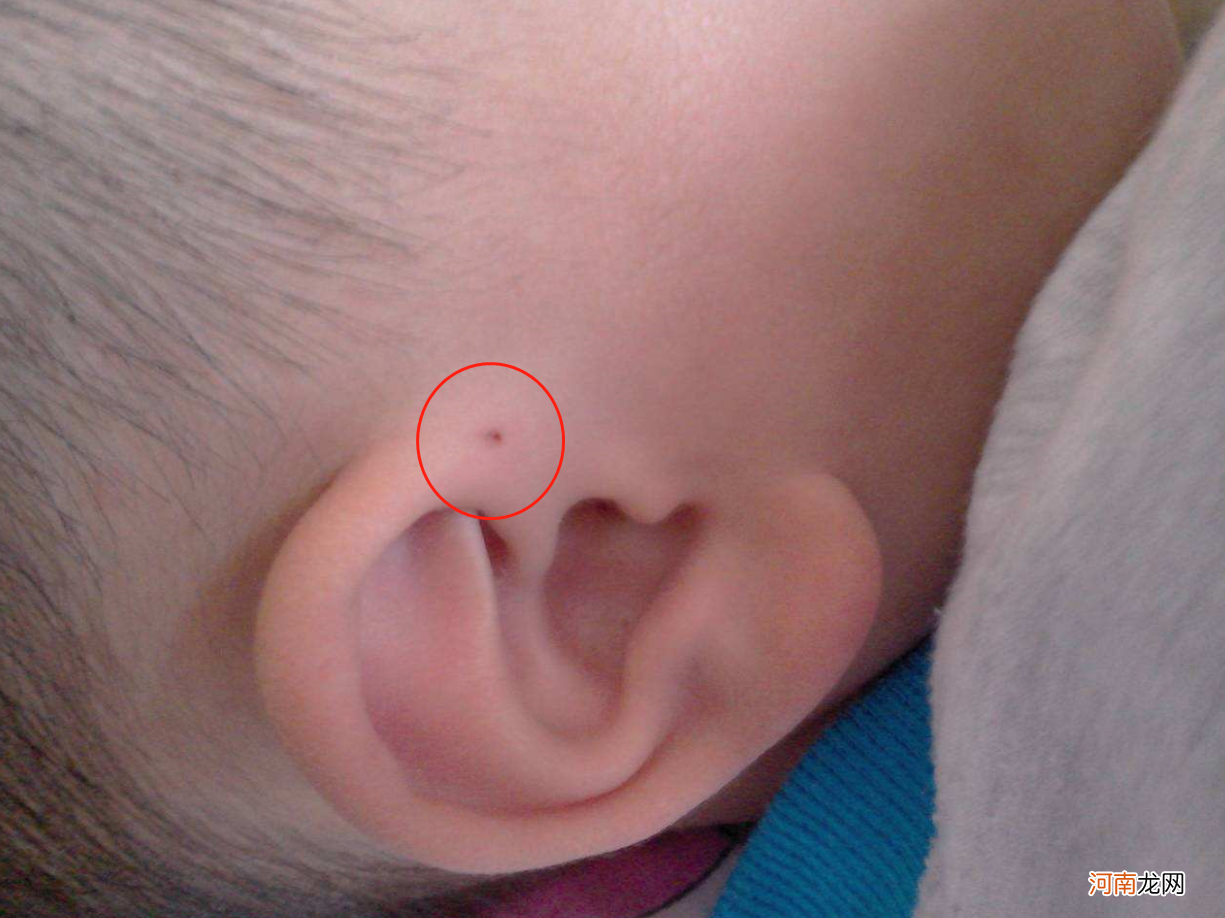 4岁孩子耳旁长出“聪明孔”，奶奶随手一挤，被医生指责不懂常识