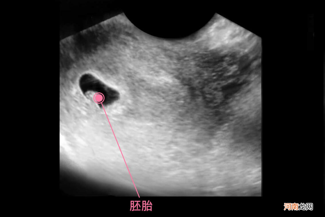 怀孕5-6周，胎儿是什么样子？胎宝宝的模样妈妈们一定想不到