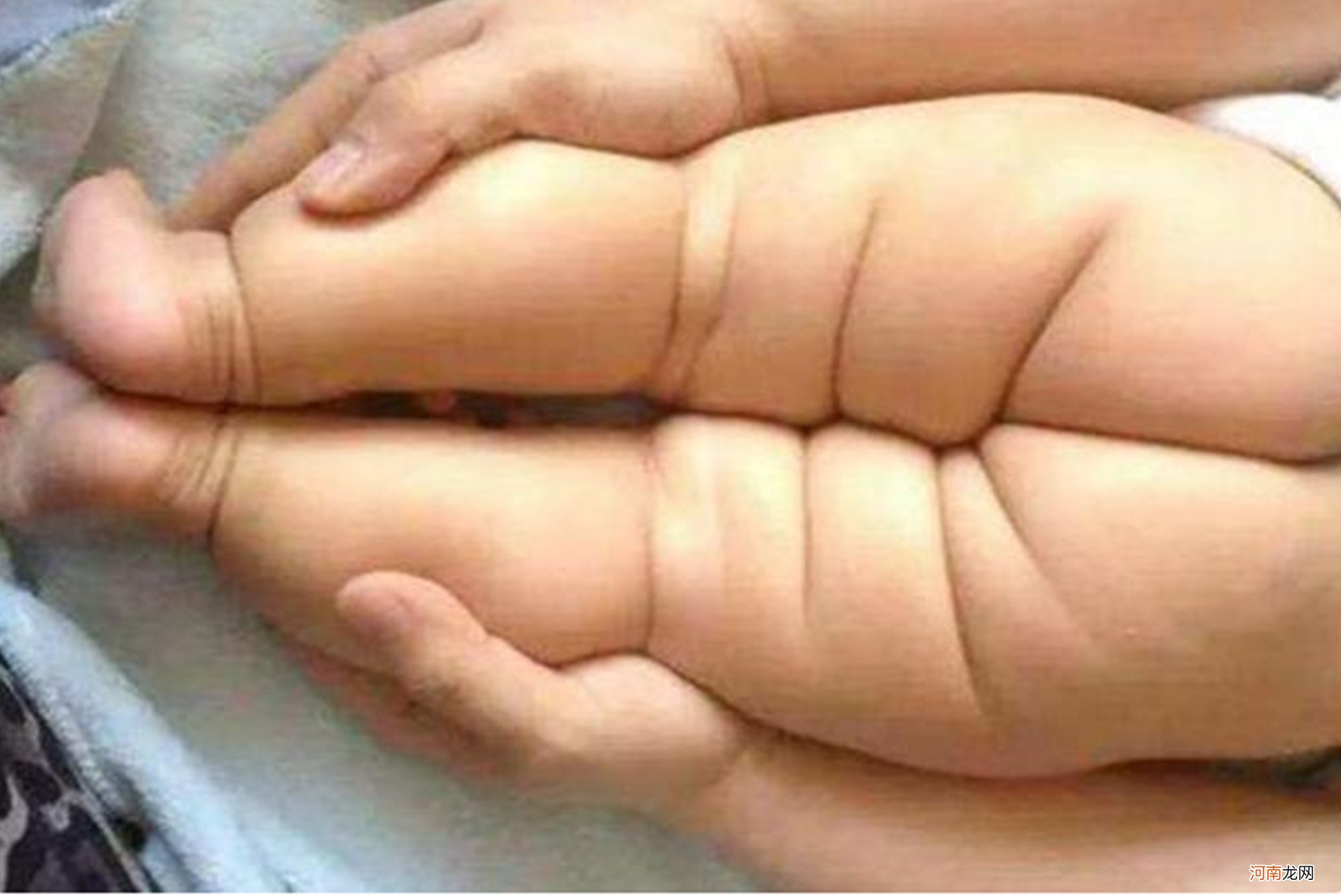 宝宝的臀纹不对称不仅“屁蛋丑”，还有发育隐患，错过难弥补