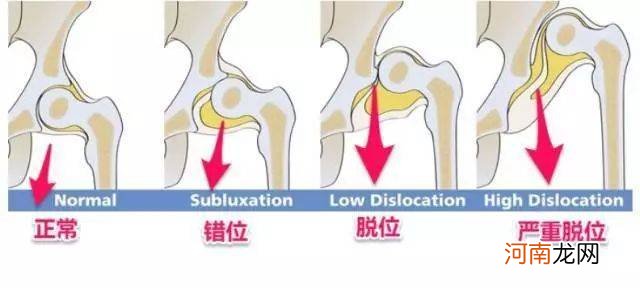 宝宝的臀纹不对称不仅“屁蛋丑”，还有发育隐患，错过难弥补