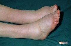 双脚浮肿是怎么回事 脚浮肿的原因有哪些