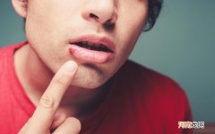 嘴角长疱疹是什么原因 嘴角长的小水泡该怎么办