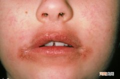 口周皮炎的保健措施 怎么保健口周皮炎呢