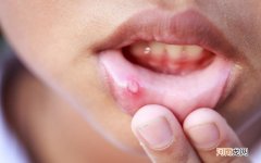 口腔溃疡为什么总是发作 经常口腔溃疡是什么原因