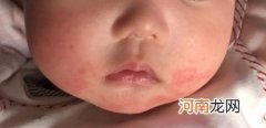 得了湿疹如何护理 如何预防婴儿湿疹