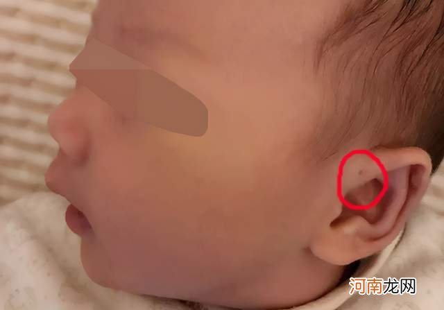 宝宝耳朵上的孔是“聪明孔”？家长别傻了，这可不是什么好兆头