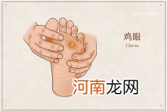 鸡眼是什么东西 鸡眼是什么原因引起的