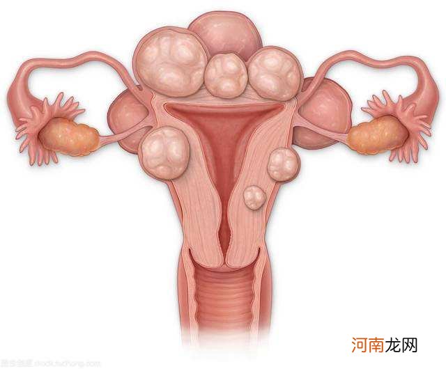 宫颈纳囊是什么 宫颈纳囊怎么办