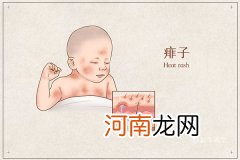 痱子和湿疹的区别 如何区分痱子和湿疹