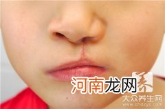 先天性腭裂能治好吗 先天性腭裂有什么后遗症