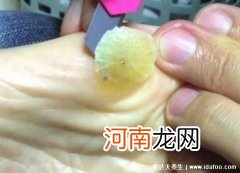 鸡眼挖出来的肉刺图