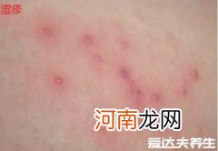 湿疹和热疹的区别图片