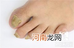 脚指甲变厚有什么影响？ 脚上指甲变厚