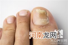 灰指甲前期症状图片 灰指甲最初的症状表现图片