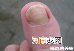 灰指甲的前兆图片 最轻微的初早期灰指甲图片