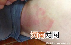 大腿内侧腹股沟癣图片 真实大腿肚内侧股癣图片